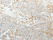 The image on the left is immunohistochemistry of paraffin-embedded Human esophagus cancer tissue using CSB-PA296975(TNC Antibody) at dilution 1/30, on the right is treated with synthetic peptide. (Original magnification: ×200)
