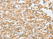 The image on the left is immunohistochemistry of paraffin-embedded Human thyroid cancer tissue using CSB-PA296982(TLR5 Antibody) at dilution 1/30, on the right is treated with fusion protein. (Original magnification: ×200)