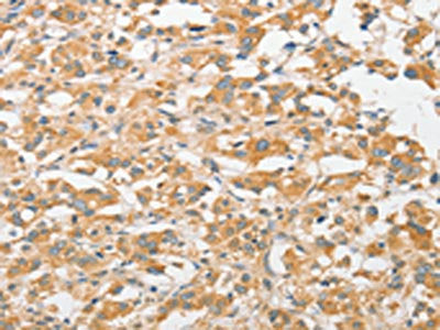 The image on the left is immunohistochemistry of paraffin-embedded Human thyroid cancer tissue using CSB-PA296982(TLR5 Antibody) at dilution 1/30, on the right is treated with fusion protein. (Original magnification: ×200)