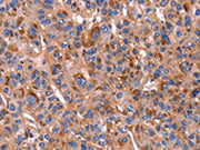 The image on the left is immunohistochemistry of paraffin-embedded Human liver cancer tissue using CSB-PA297000(PVR Antibody) at dilution 1/20, on the right is treated with fusion protein. (Original magnification: ×200)
