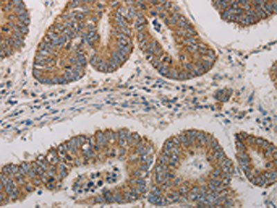 The image on the left is immunohistochemistry of paraffin-embedded Human colon cancer tissue using CSB-PA297162(CDKN1A Antibody) at dilution 1/20, on the right is treated with fusion protein. (Original magnification: ×200)