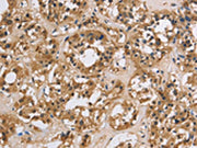 The image on the left is immunohistochemistry of paraffin-embedded Human thyroid cancer tissue using CSB-PA297207(IMPDH1 Antibody) at dilution 1/20, on the right is treated with synthetic peptide. (Original magnification: ×200)