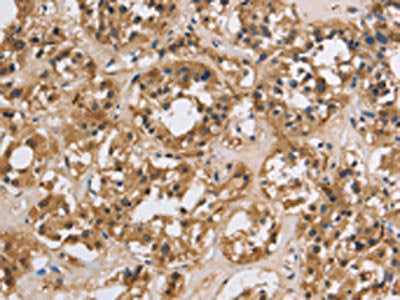 The image on the left is immunohistochemistry of paraffin-embedded Human thyroid cancer tissue using CSB-PA297207(IMPDH1 Antibody) at dilution 1/20, on the right is treated with synthetic peptide. (Original magnification: ×200)