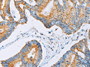 The image on the left is immunohistochemistry of paraffin-embedded Human colon cancer tissue using CSB-PA297340(ACAA2 Antibody) at dilution 1/30, on the right is treated with fusion protein. (Original magnification: ×200)