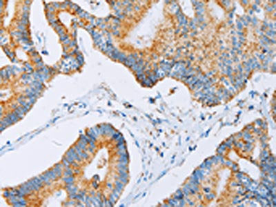 The image on the left is immunohistochemistry of paraffin-embedded Human colon cancer tissue using CSB-PA297340(ACAA2 Antibody) at dilution 1/30, on the right is treated with fusion protein. (Original magnification: ×200)