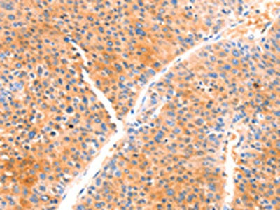 The image on the left is immunohistochemistry of paraffin-embedded Human liver cancer tissue using CSB-PA297520(PRDX2 Antibody) at dilution 1/80, on the right is treated with synthetic peptide. (Original magnification: ×200)