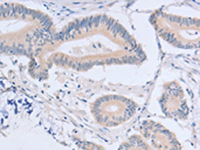 The image on the left is immunohistochemistry of paraffin-embedded Human colon cancer tissue using CSB-PA297536(ACMSD Antibody) at dilution 1/15, on the right is treated with fusion protein. (Original magnification: ×200)