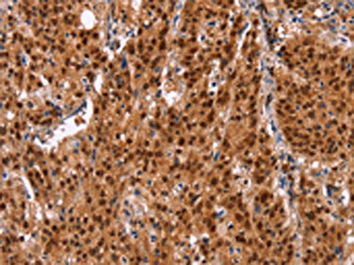 The image on the left is immunohistochemistry of paraffin-embedded Human gastic cancer tissue using CSB-PA297560(HRK Antibody) at dilution 1/20, on the right is treated with synthetic peptide. (Original magnification: ×200)