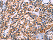 The image on the left is immunohistochemistry of paraffin-embedded Human thyroid cancer tissue using CSB-PA297913(STXBP2 Antibody) at dilution 1/20, on the right is treated with fusion protein. (Original magnification: ×200)