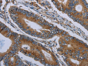 The image on the left is immunohistochemistry of paraffin-embedded Human colon cancer tissue using CSB-PA297988(FPR3 Antibody) at dilution 1/20, on the right is treated with synthetic peptide. (Original magnification: ×200)