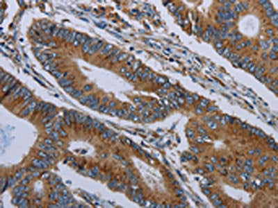 The image on the left is immunohistochemistry of paraffin-embedded Human colon cancer tissue using CSB-PA297988(FPR3 Antibody) at dilution 1/20, on the right is treated with synthetic peptide. (Original magnification: ×200)