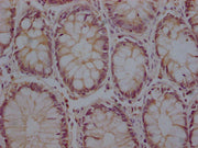 IHC image of CSB-PA29809A0Rb diluted at 1:200 and staining in paraffin-embedded human colon cancer performed on a Leica BondTM system. After dewaxing and hydration, antigen retrieval was mediated by high pressure in a citrate buffer (pH 6.0). Sect...