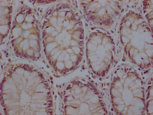 IHC image of CSB-PA29809A0Rb diluted at 1:200 and staining in paraffin-embedded human colon cancer performed on a Leica BondTM system. After dewaxing and hydration, antigen retrieval was mediated by high pressure in a citrate buffer (pH 6.0). Sect...