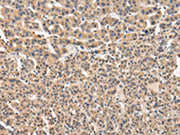 The image on the left is immunohistochemistry of paraffin-embedded Human liver cancer tissue using CSB-PA298138(VPS41 Antibody) at dilution 1/20, on the right is treated with fusion protein. (Original magnification: ×200)