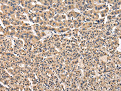 The image on the left is immunohistochemistry of paraffin-embedded Human liver cancer tissue using CSB-PA298138(VPS41 Antibody) at dilution 1/20, on the right is treated with fusion protein. (Original magnification: ×200)