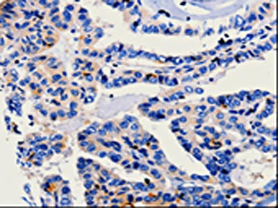 The image on the left is immunohistochemistry of paraffin-embedded Human thyroid cancer tissue using CSB-PA298167(CA3 Antibody) at dilution 1/25, on the right is treated with fusion protein. (Original magnification: ×200)