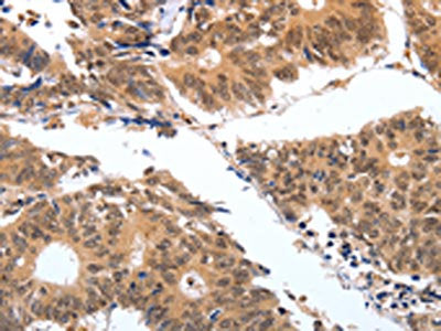 The image on the left is immunohistochemistry of paraffin-embedded Human colon cancer tissue using CSB-PA298172(PGC Antibody) at dilution 1/25, on the right is treated with fusion protein. (Original magnification: ×200)