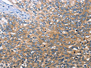 The image on the left is immunohistochemistry of paraffin-embedded Human cervical cancer tissue using CSB-PA298431(BRE Antibody) at dilution 1/30, on the right is treated with fusion protein. (Original magnification: ×200)