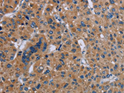 The image on the left is immunohistochemistry of paraffin-embedded Human liver cancer tissue using CSB-PA298467(IL27RA Antibody) at dilution 1/40, on the right is treated with fusion protein. (Original magnification: ×200)