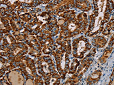 The image on the left is immunohistochemistry of paraffin-embedded Human thyroid cancer tissue using CSB-PA298637(MRPL12 Antibody) at dilution 1/25, on the right is treated with fusion protein. (Original magnification: ×200)