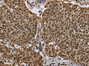 The image on the left is immunohistochemistry of paraffin-embedded Human cervical cancer tissue using CSB-PA298674(PPAT Antibody) at dilution 1/50, on the right is treated with fusion protein. (Original magnification: ×200)
