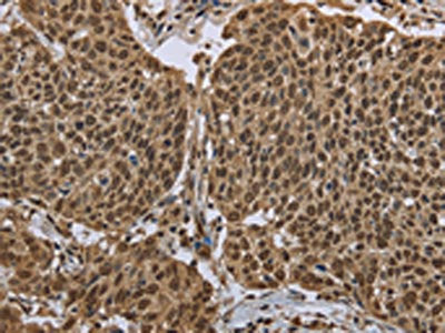 The image on the left is immunohistochemistry of paraffin-embedded Human cervical cancer tissue using CSB-PA298674(PPAT Antibody) at dilution 1/50, on the right is treated with fusion protein. (Original magnification: ×200)