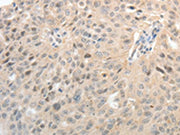 The image on the left is immunohistochemistry of paraffin-embedded Human ovarian cancer tissue using CSB-PA298683(ASCL1 Antibody) at dilution 1/30, on the right is treated with synthetic peptide. (Original magnification: ×200)