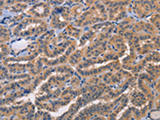 The image on the left is immunohistochemistry of paraffin-embedded Human thyroid cancer tissue using CSB-PA298726(AKR1B10 Antibody) at dilution 1/20, on the right is treated with fusion protein. (Original magnification: ×200)