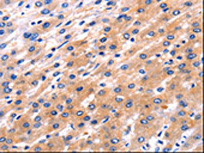 The image on the left is immunohistochemistry of paraffin-embedded Human liver cancer tissue using CSB-PA298750(RAB39A Antibody) at dilution 1/5, on the right is treated with synthetic peptide. (Original magnification: ×200)