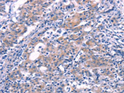 The image on the left is immunohistochemistry of paraffin-embedded Human gastic cancer tissue using CSB-PA299070(FGF16 Antibody) at dilution 1/30, on the right is treated with synthetic peptide. (Original magnification: ×200)