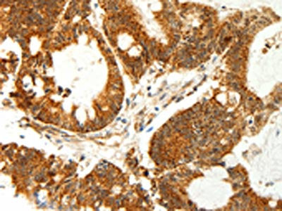 The image on the left is immunohistochemistry of paraffin-embedded Human colon cancer tissue using CSB-PA299234(COX7B Antibody) at dilution 1/60, on the right is treated with fusion protein. (Original magnification: ×200)
