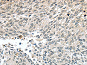 The image on the left is immunohistochemistry of paraffin-embedded Human lung cancer tissue using CSB-PA299544(PALB2 Antibody) at dilution 1/30, on the right is treated with synthetic peptide. (Original magnification: ×200)