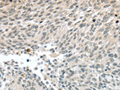 The image on the left is immunohistochemistry of paraffin-embedded Human lung cancer tissue using CSB-PA299544(PALB2 Antibody) at dilution 1/30, on the right is treated with synthetic peptide. (Original magnification: ×200)