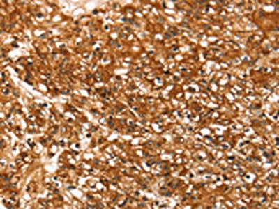 The image on the left is immunohistochemistry of paraffin-embedded Human prostate cancer tissue using CSB-PA299624(SLC16A3 Antibody) at dilution 1/30, on the right is treated with synthetic peptide. (Original magnification: ×200)