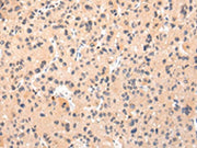 The image on the left is immunohistochemistry of paraffin-embedded Human liver cancer tissue using CSB-PA299655(IKZF4 Antibody) at dilution 1/25, on the right is treated with synthetic peptide. (Original magnification: ×200)