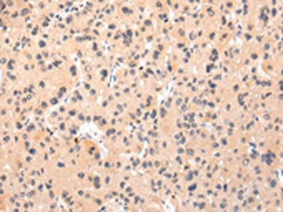 The image on the left is immunohistochemistry of paraffin-embedded Human liver cancer tissue using CSB-PA299655(IKZF4 Antibody) at dilution 1/25, on the right is treated with synthetic peptide. (Original magnification: ×200)