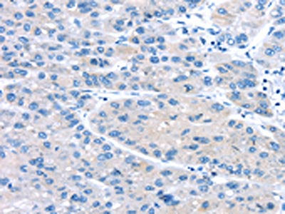 The image on the left is immunohistochemistry of paraffin-embedded Human liver cancer tissue using CSB-PA299698(UCP2 Antibody) at dilution 1/20, on the right is treated with synthetic peptide. (Original magnification: ×200)