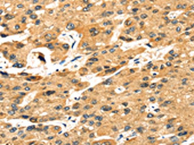 The image on the left is immunohistochemistry of paraffin-embedded Human liver cancer tissue using CSB-PA299879(STX8 Antibody) at dilution 1/35, on the right is treated with fusion protein. (Original magnification: ×200)