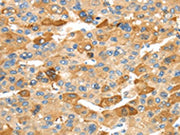 The image on the left is immunohistochemistry of paraffin-embedded Human liver cancer tissue using CSB-PA299946(RHCG Antibody) at dilution 1/30, on the right is treated with synthetic peptide. (Original magnification: ×200)