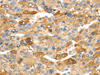 The image on the left is immunohistochemistry of paraffin-embedded Human liver cancer tissue using CSB-PA299946(RHCG Antibody) at dilution 1/30, on the right is treated with synthetic peptide. (Original magnification: ×200)