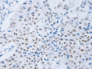 The image on the left is immunohistochemistry of paraffin-embedded Human lung cancer tissue using CSB-PA300271(CSF1R Antibody) at dilution 1/45, on the right is treated with synthetic peptide. (Original magnification: ×200)
