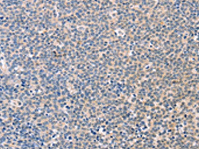 The image on the left is immunohistochemistry of paraffin-embedded Human Lymphoma tissue using CSB-PA300302(NCAM1 Antibody) at dilution 1/30, on the right is treated with synthetic peptide. (Original magnification: ×200)