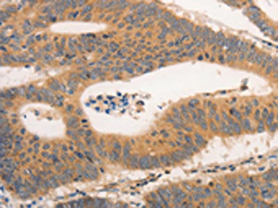 The image on the left is immunohistochemistry of paraffin-embedded Human colon cancer tissue using CSB-PA300322(CSF3R Antibody) at dilution 1/15, on the right is treated with synthetic peptide. (Original magnification: ×200)