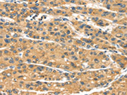 The image on the left is immunohistochemistry of paraffin-embedded Human liver cancer tissue using CSB-PA300448(MACC1 Antibody) at dilution 1/35, on the right is treated with synthetic peptide. (Original magnification: ×200)