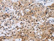 The image on the left is immunohistochemistry of paraffin-embedded Human lung cancer tissue using CSB-PA301733(NEB Antibody) at dilution 1/80, on the right is treated with synthetic peptide. (Original magnification: ×200)