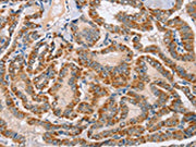 The image on the left is immunohistochemistry of paraffin-embedded Human thyroid cancer tissue using CSB-PA301850(MSMB Antibody) at dilution 1/30, on the right is treated with fusion protein. (Original magnification: ×200)
