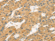 The image on the left is immunohistochemistry of paraffin-embedded Human liver cancer tissue using CSB-PA302315(MAPK12 Antibody) at dilution 1/25, on the right is treated with fusion protein. (Original magnification: ×200)
