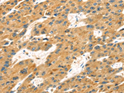 The image on the left is immunohistochemistry of paraffin-embedded Human liver cancer tissue using CSB-PA302315(MAPK12 Antibody) at dilution 1/25, on the right is treated with fusion protein. (Original magnification: ×200)