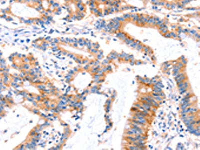 The image on the left is immunohistochemistry of paraffin-embedded Human colon cancer tissue using CSB-PA304145(MLLT4 Antibody) at dilution 1/30, on the right is treated with synthetic peptide. (Original magnification: ×200)