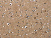 The image on the left is immunohistochemistry of paraffin-embedded Human brain tissue using CSB-PA304185(PHKG2 Antibody) at dilution 1/30, on the right is treated with synthetic peptide. (Original magnification: ×200)